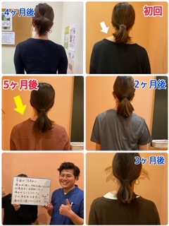 左肩の盛り上りが気になる の症例写真