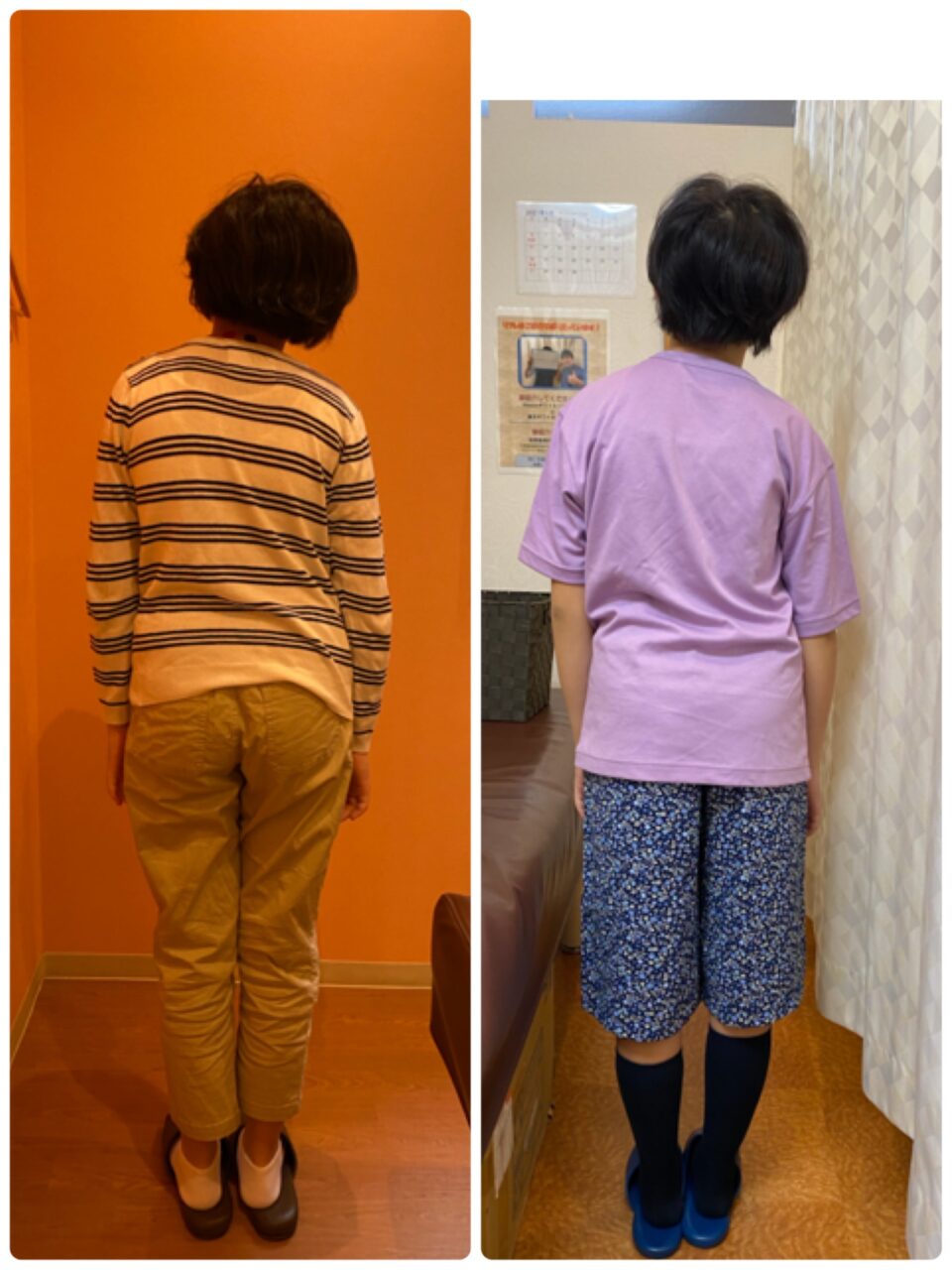 側弯症には治療の順序がある の症例写真