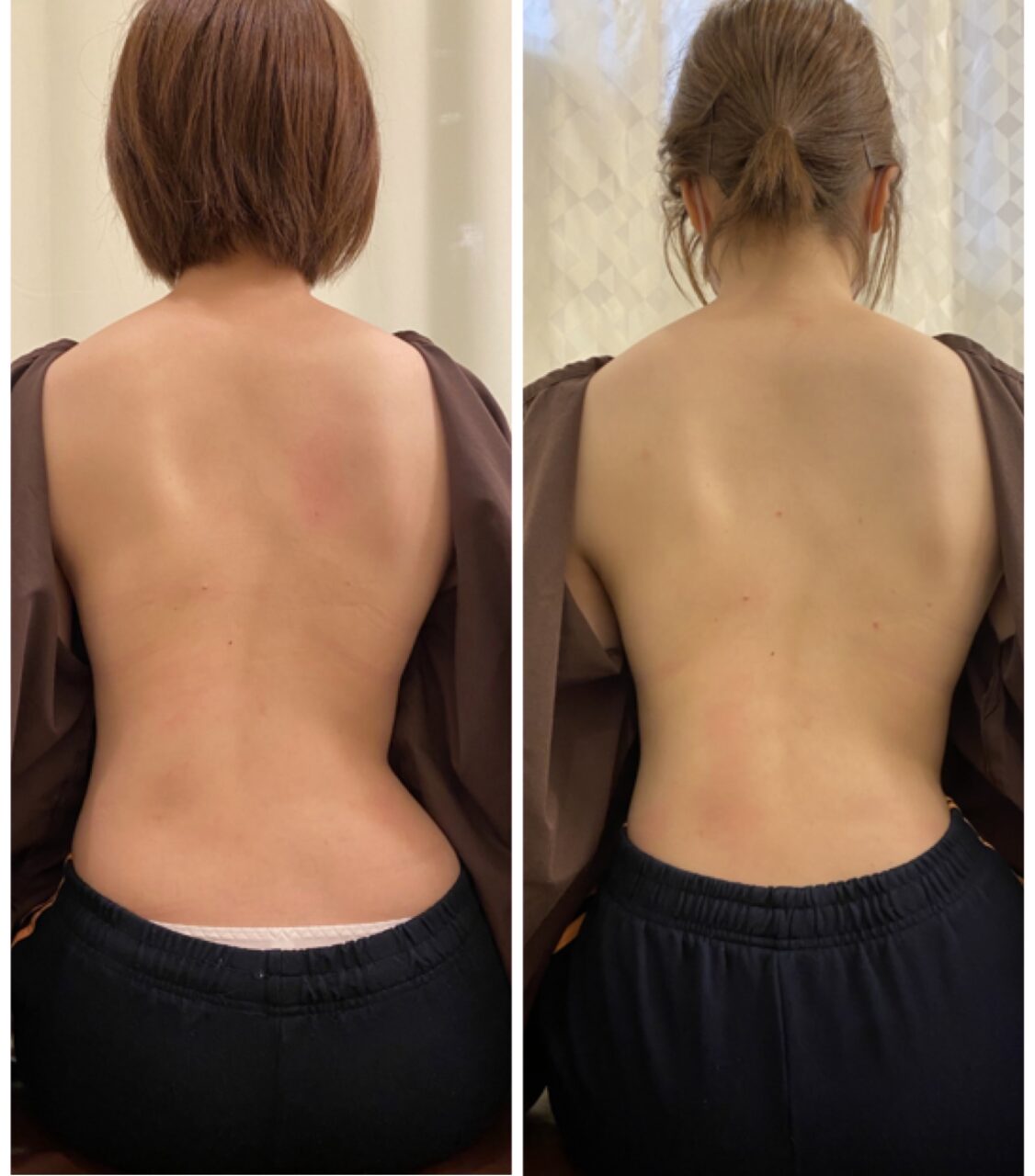 くびれの左右差も改善する の症例写真