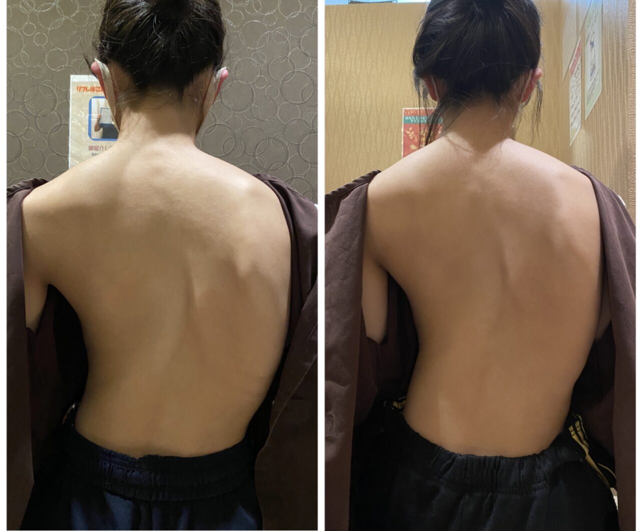 側弯症の角度が70度だって諦めちゃダメ の症例写真