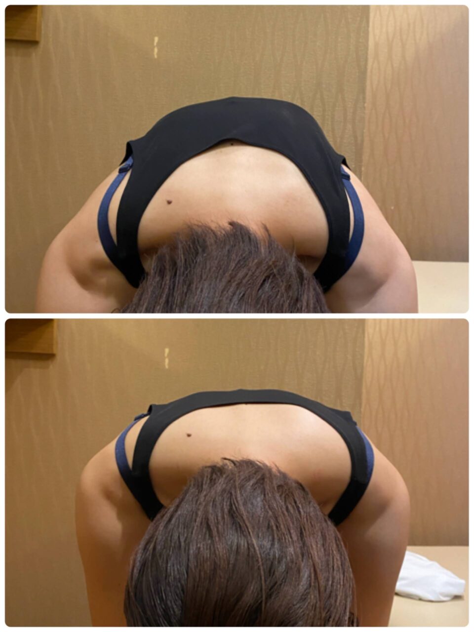 背中も盛り上がりはエクササイズでつぶす の症例写真