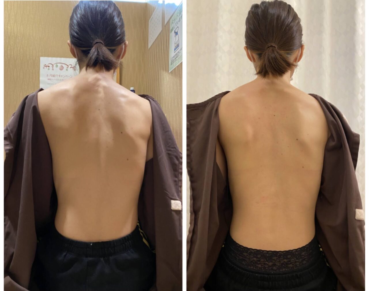 肩の高さが違うのは背骨が原因 の症例写真