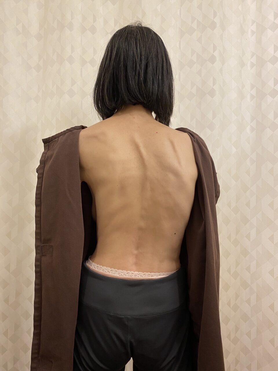 頭痛の原因は背骨のズレ の症例写真