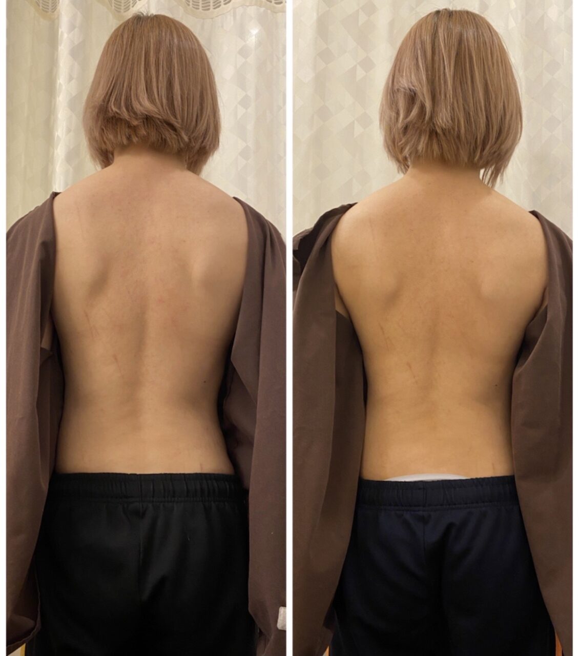 側弯症と痛みは関係ない の症例写真
