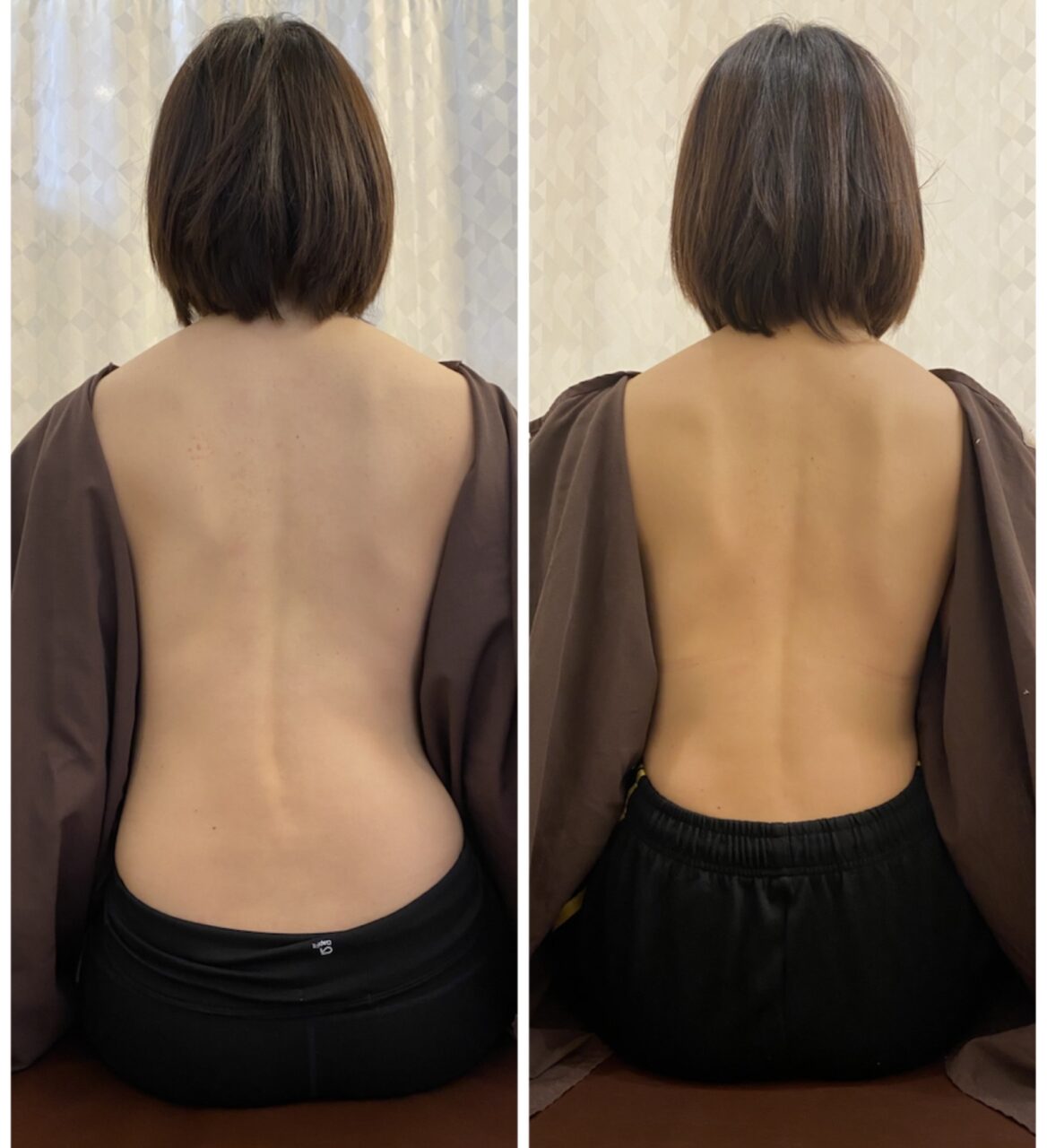 側弯症改善の鍵はポジティブに生きること の症例写真
