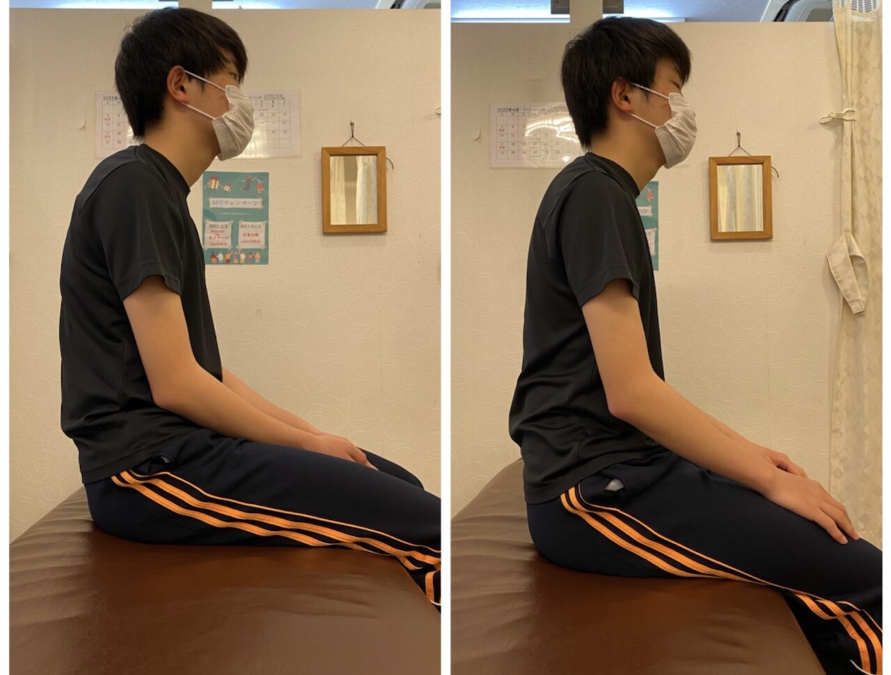 側弯症は猫背も併発する の症例写真