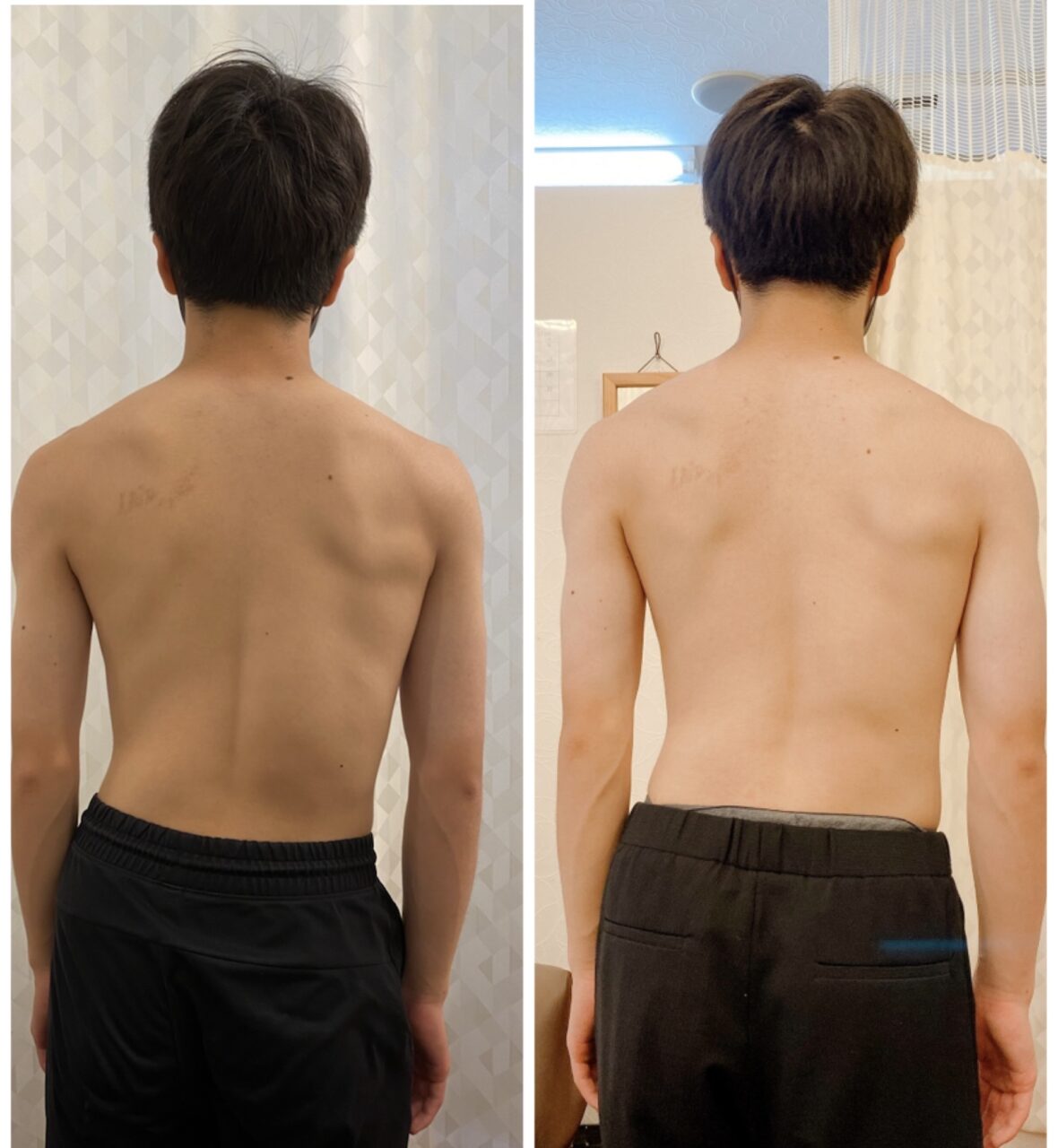 男性の筋肉は弯曲を固める の症例写真