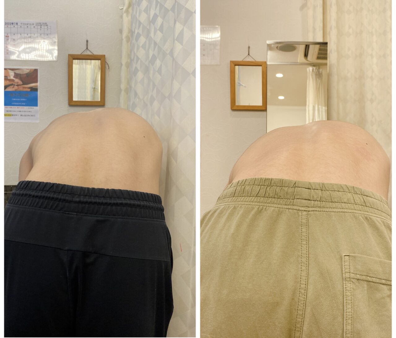側弯症は筋トレするな の症例写真